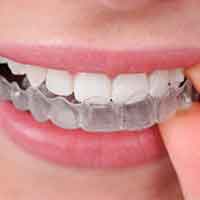 Invisalign aligner on a woman's teeth